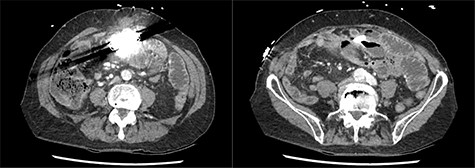Axial slices of computed tomography scan showing beam hardening artefact from intra-abdominal AICD, adjacent to distended loops of small bowel.