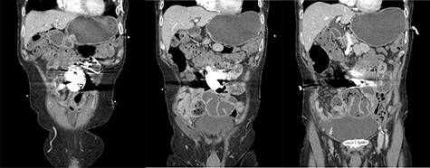 Coronal slices of computed tomography scan shown beam hardening artefact from intra-abdominal AICD, adjacent to distended loops of small bowel.