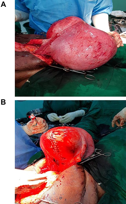 (A) Lateral view of myomatous uterus after delivery of the baby; (B) posterior view of myomatous uterus after repair of uterine incision.