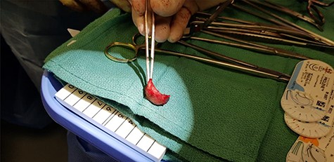 Clot around the inflow cannula of the LVAD.