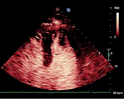 Pre-operative echocardiogram showing LV thrombus.