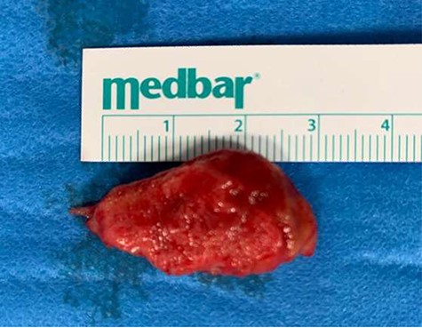 Thrombus folllowing extraction from left ventricle.