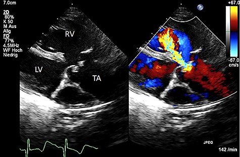 Color Doppler echocardiography in the parasternal long axis view shows severe TV regurgitation. RV: right ventricle, LV: left ventricle, TA: truncus arteriosus.