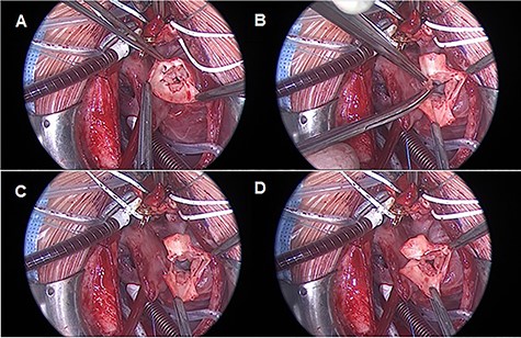 TV reconstruction. (A) Leaflet identification. (B and C) Leaflet resection. (D) Local annuloplasty and aortic valve suture.