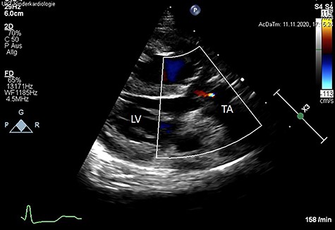Post-operative color Doppler echocardiography (parasternal long axis view) reveals a competent TV with just a minor trace of central regurgitation. Ao: Aorta, LV: left ventricle, TA: truncus arteriosus.