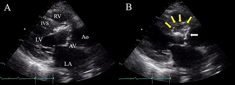 Preoperative TTE (parasternal long-axis view) showing vegetation on the aortic valve (white arrow) and aortic annular abscess extending to the IVS (yellow arrows); (A) end-systolic phase; (B) end-diastolic phase; LV, left ventricle; RV, right ventricle; LA, left atrium; AV, aortic valve; Ao, ascending aorta.