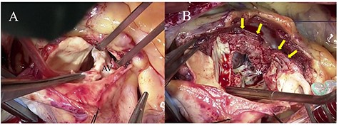 Intraoperative photographs; (A) a severely calcified and infected aortic valve was resected; (B) aortic annular abscess (asterisk) extending to the IVS (yellow arrow) was opened widely by Konno incision.