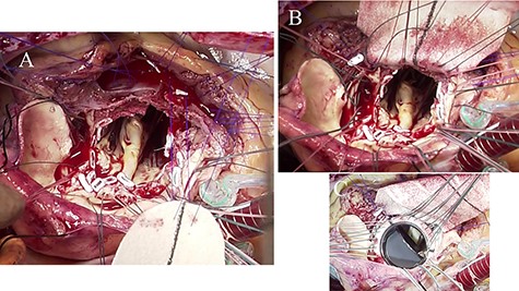 Intraoperative photographs; (A) bottom half of the Dacron patch trimmed into the shape of foliage was sutured to the debrided IVS using 4-0 polypropylene mattress sutures with feft-pledgets; (B) aortic annulus and IVS were reconstructed by the Dacron patch; (C) a St. Jude Medical 27-mm mechanical valve was implanted in the reconstructed aortic annulus.