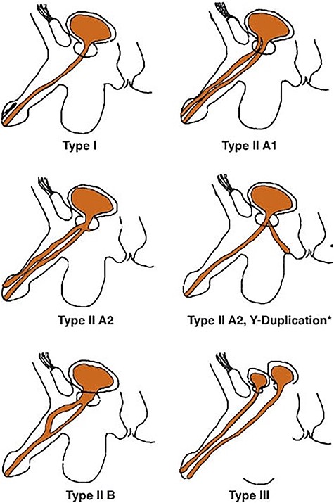 Classification of urethral duplications according to Effman.