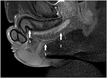 Pelvis MRI: horizontal one-eyed fistula (1) on the medial ligne above the corpus spongiosum (2), ending vertically with no collection and (3) corpus cavernosum.