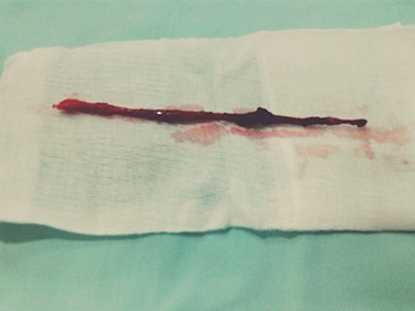 The blind channel after excision.