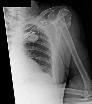 Antero-posterior view X-ray taken on day of admission, showing a left surgical neck of humerus fracture with anterior displacement of the proximal humeral shaft.