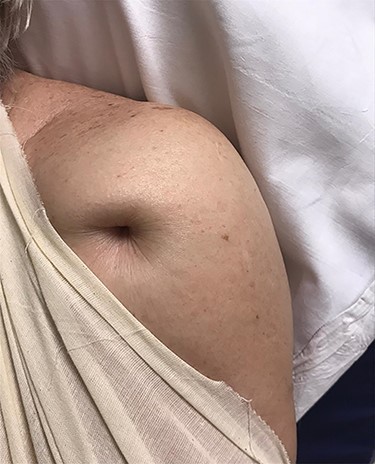 Clinical picture showing ‘Pucker sign’ on the left shoulder (anterior view).