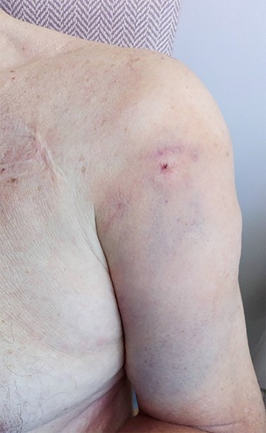 Clinical picture showing un-puckered left shoulder and localized ecchymoses of the anterior arm (anterior view).
