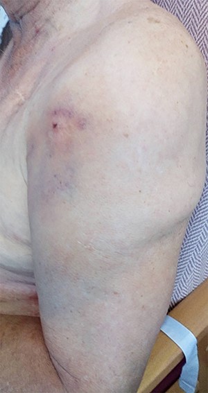 Clinical picture showing un-puckered left shoulder and localized ecchymoses of the anterior arm (lateral view).