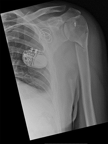 Antero-posterior view X-ray taken 1 week post-injury showing acceptable positioning of the fracture.