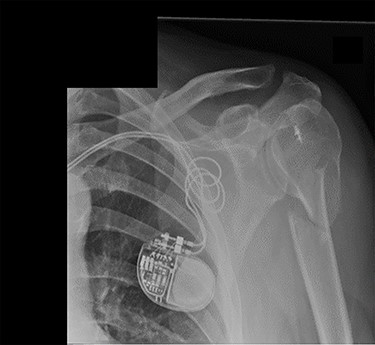 Antero-posterior view X-ray taken 2 weeks post-injury showing acceptable positioning of the fracture.