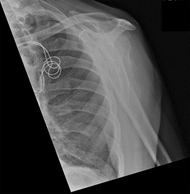 Lateral scapula (Y) view X-ray taken 6 weeks post-injury showing radiological healing of the fracture.