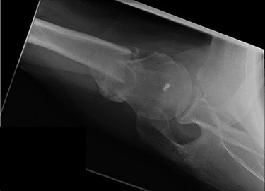 Axial view X-ray taken 14 weeks post-injury showing excellent fracture union and articulation between the humeral head and glenoid.