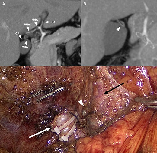 (A) Arterial anatomy; the MHA derived from the hilum of the hepatic artery and the CA arising from the MHA (B) The MHA that runs into segment IV (C) Anatomical structures after cholecystectomy; white arrow: cystic duct stump, white wedge: CA stump, and black arrow: MHA. LHA, left hepatic artery; MHA, middle hepatic artery; RHA, right hepatic artery; CA, cystic artery.