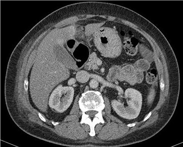 Contrast-enhanced CT scan shows a 32 × 22-mm oval-shaped fat density lesion with peripheral hyperattenuation and central hyperdense dot adjacent to falciform ligament. There is surrounding oedema and inflammation. Gall bladder is noted to be unremarkable. Features represent intraperitoneal focal fat infarction of fatty appendage of falciform ligament.