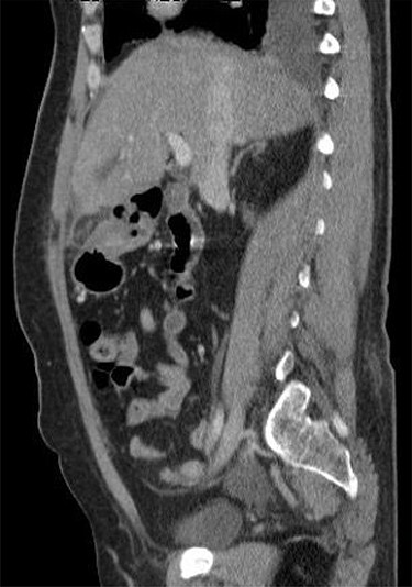 Sagittal reconstruction redemonstrates central hyperdense thrombosed vessel secondary to torsion