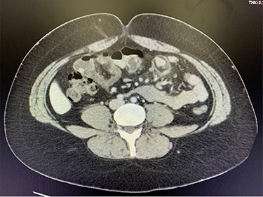 CT consistent with small bowel intussusception and inflammatory changes at the mesentery.