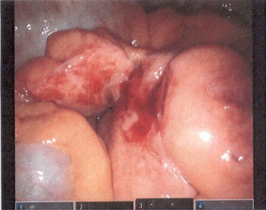 Mesentery appears to be noticeably thickened.