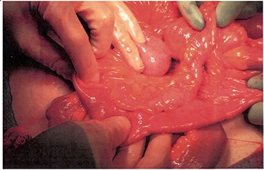 Medial tract presumed to be a duplicated portion of small bowel.