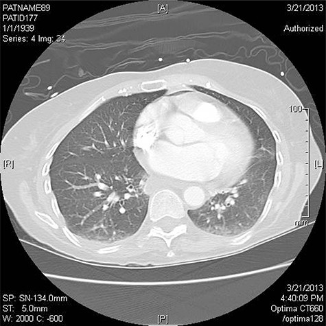 CT scan revealing pneumomediastinum.