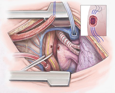 Artist illustration shows closure of atrial portion of fistula.