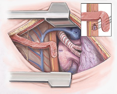 Artist illustration shows closure of esophageal portion of fistula and intercostal muscle flap placement.