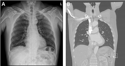 Radiographic findings. (A) Initial chest X-ray showed no evidence of hemothorax. (B) Initial chest CT also showed no evidence of hemothorax.