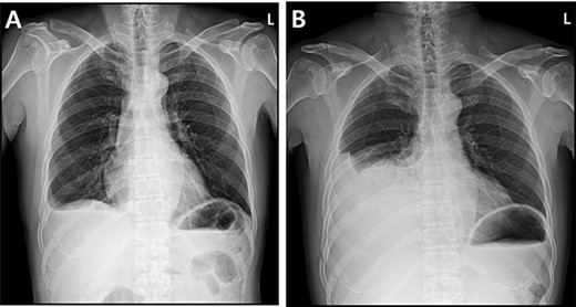 Radiographic findings. (A) Day of symptoms, chest X-ray in the morning. (B) Chest X-ray after symptoms develop.