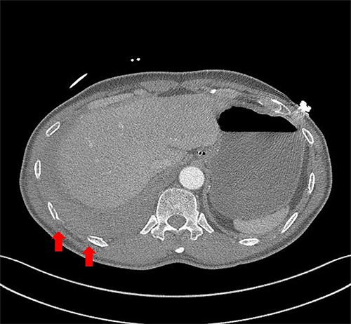 Chest contrast-enhanced CT showed massive hemothorax with multiple rib fractures including 10th, 11th ribs (arrow) with no active extravasation of contrast.