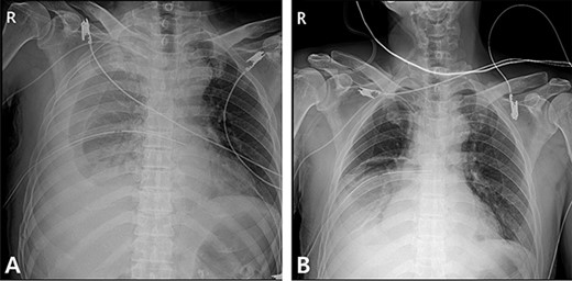 Radiographic findings. (A) After chest tube insertion. (B) 12 h after chest tube insertion.