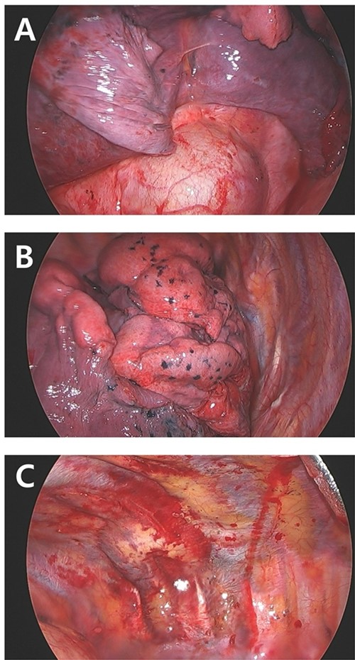 Intraoperative finding. (A) No active bleeding focus on right diaphragm. (B) Lung contusion but no bleeding. (C) Pleural laceration due to fractured and displaced 10th rib (arrow).