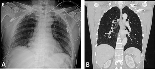 Radiography and CT scan findings. (A) Immediate postoperative chest radiography. (B) A month after surgery, outpatient chestCT.