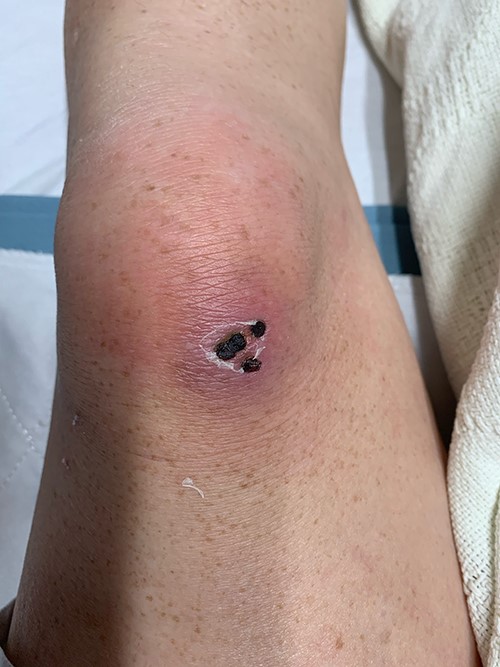 Firm nontender violaceous nodule with necrotic papules.