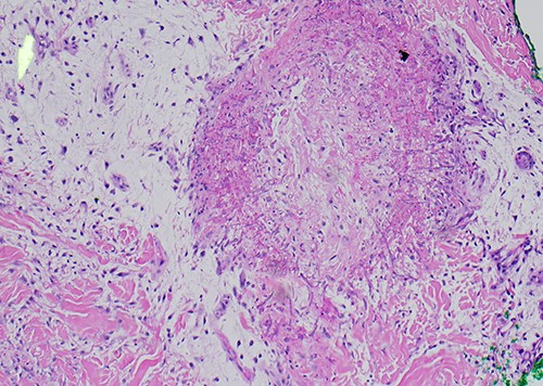 Original biopsy with numerous fungal hyphae demonstrating angioinvasion (H&E).