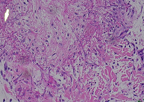 Higher magnification further demonstrating transmural invasion of fungal organisms (H&E).