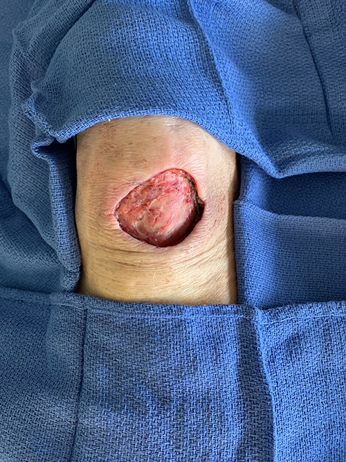 Patient’s knee after excision.