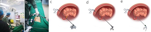 The key procedure of SLAN. (a) Position of surgeon and assistant. (b) Position of surgical incision, trocars and needle grasping forceps. (c) Needle grasping forceps was used to pull the appendix and ultrasonic knife was used to cutoff the mesentery. (d) Needle grasping forceps was used to separate and clamp the appendix. The root of the appendix should be ligated with 7–0 surgical surture. (e) A small Hem-o-lock clip was used to clamp the appendixroot.