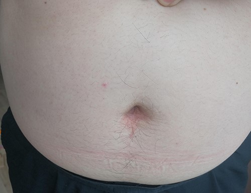 Incision healing status was observed on 9 months after surgery.