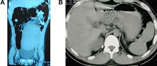 Wandering and twisted splenomegaly. (A) CT scan of the abdomen showing a displaced ectopic spleen in the left flank and pelvic region, characteristic of a wandering spleen. Observe the absence of the spleen in the left hypochondrium. (B) The spleen after detorsion and splenopexy in the left hypochondrium. Observe the reduction of the spleen to a normal size four years after the splenopexy.