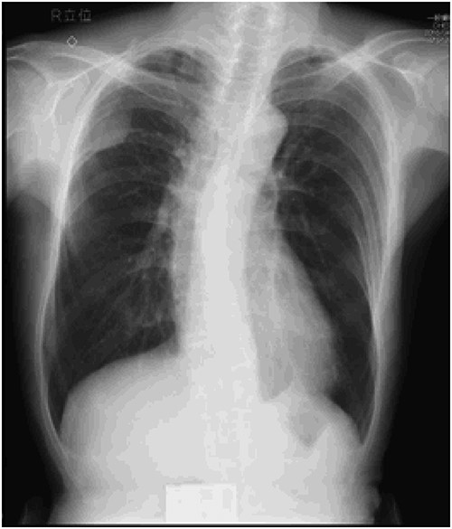 Preoperative chest X-ray: tumor shadow in the right upper lung field.