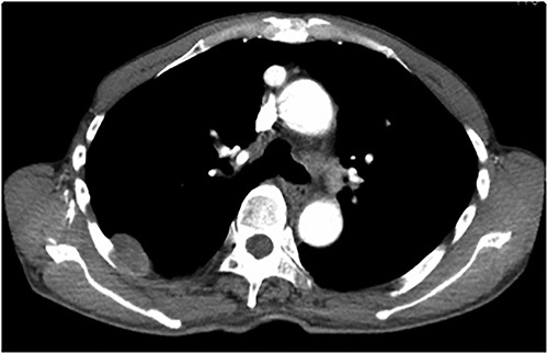 Contrast-enhanced chest CT showing a smooth surface of 3 cm.