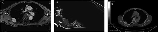 Preoperative MRI and PET-CT: (A) contrast-enhanced T1WI: hyper-intense; (B) T2WI: iso-intense; (C) PET-CT: SUVmax 3.4–4.1.