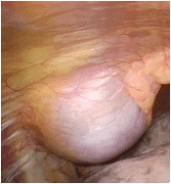 A smooth surface originating from the sixth intracostal space.