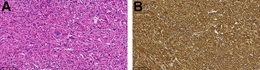 (A) The tumor was composed of highly atypical spindle cells (HE staining; magnification: bar = 100 μm); (B) α-SMA staining was positive (magnification: bar = 100 μm).